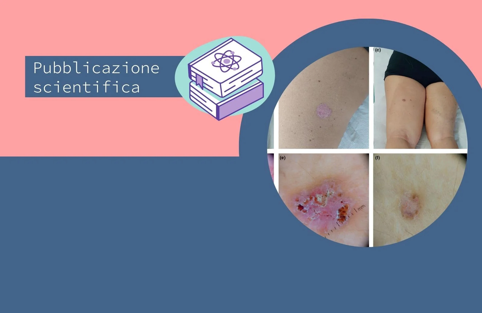 Pelle immunodepressa e carcinomi basocellulari multipli