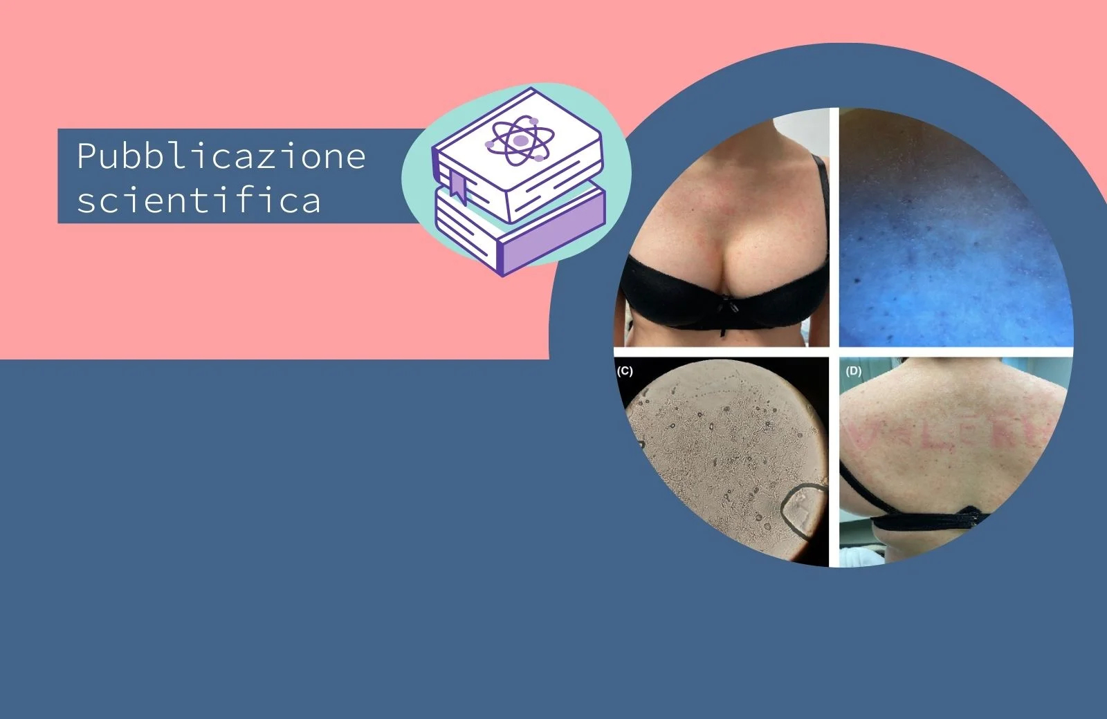 “PiMa sign”, possibile relazione fra demografismo e pitiriasi versicolor