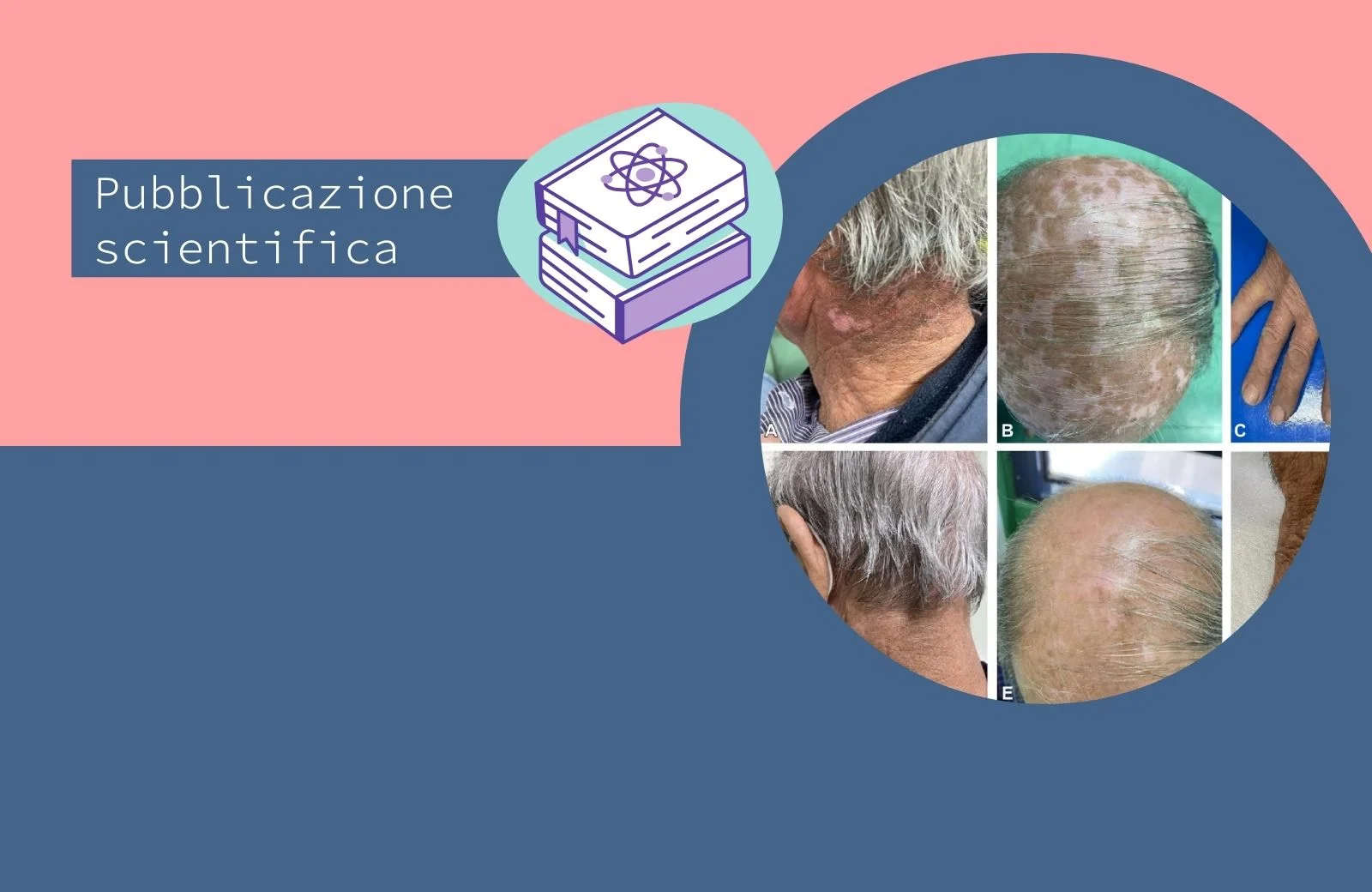 Vitiligine indotta da dupilumab nella dermatite atopica in un caso clinico