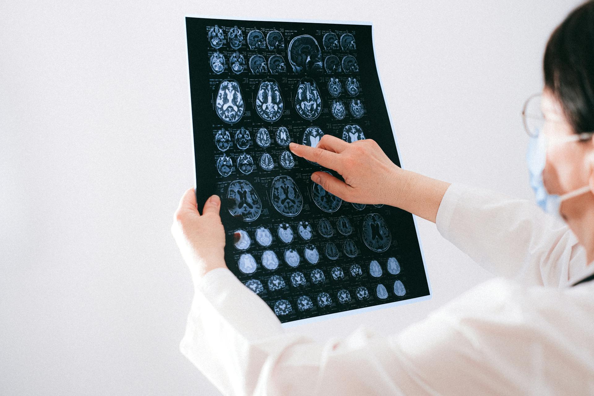 Innovazione ed avanzamenti nel trattamento della CCSVI mediante angioplastica
